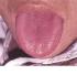 Saburra delgada de la lengua